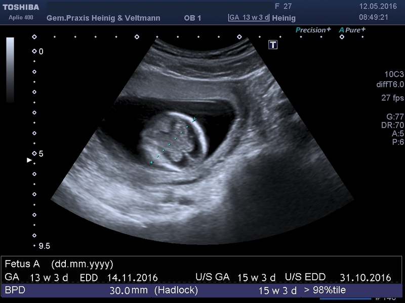 Ssw ultraschall junge 12 Sehr frühes