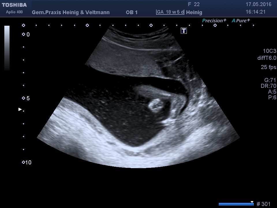 Ultraschall Hoden Baby
